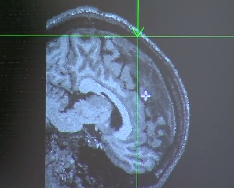 El estrés durante la infancia puede modificar el cerebro