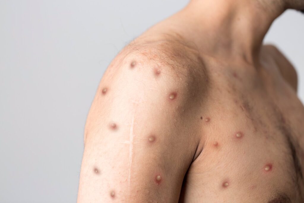 Tras analizar 185 casos recogidos de viruela del mono, los especialistas demuestran nuevos hallazgos clínicos y epidemiológicos