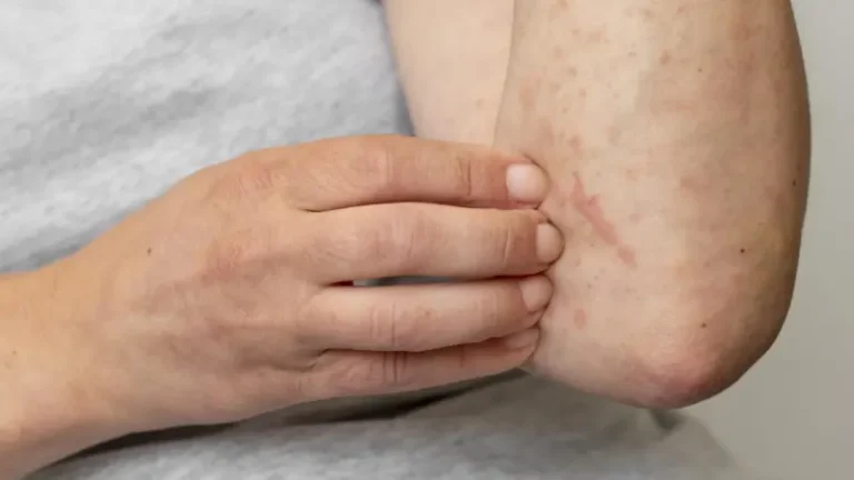 Se produce un repunte de viruela del mono en Latinoamérica