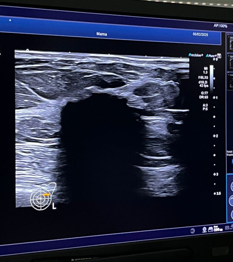 El Hospital La Candelaria incorpora la crioablación para tratar el cáncer de mama